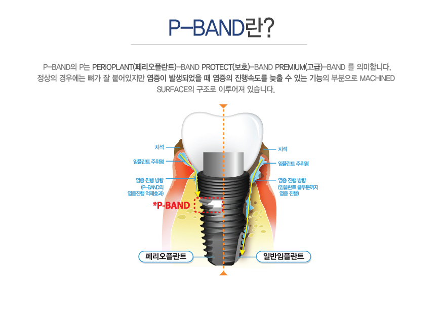 P-BAND?
	P-Band p Perioplant(丮öƮ)-Band Protect(ȣ)-Band Premium()-Band  ǹմϴ.
 쿡   پ  ߻Ǿ   ӵ   ִ  κ machined 
surface  ̷ ֽϴ. 